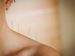 Revolution Chiropractic - Dr Mark Illguth - Massage Services - Dry Needling