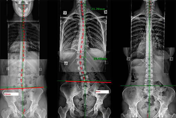 Traditional Chiro Vs Revolution Chiropractic