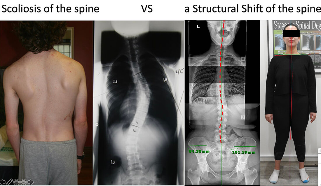 Scoliosis Chiropractor in Miami - Blog - Mark Ilgguth - Revolution Chiropractic - Image